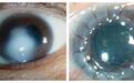 角膜盲患者的福音 郑州爱尔眼科医院角膜移植正式通过医疗技术备案