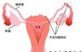 潍坊市人民医院|【节日里的健康】世界子宫内膜异位症日--正确认识子宫内膜异位症