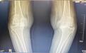 【品质世博】病例讨论：83岁高龄患者双腿膝关节置换