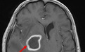 健康科普｜谈谈脑脓肿