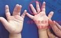 上饶男童双手“并指” 医生开展矫形术助他双双“分手”