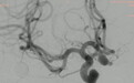 西安交大二附院动脉瘤WEB™SL植入术巧拆“颅内炸弹”