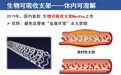 生物可吸收支架：“介入无植入”创新技术为冠心病患者开启生命“通道”