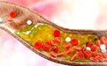 阿托伐他汀钙片主治疾病有哪些？高效降脂、坚持使用护心又护脑