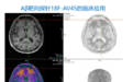 省内唯一！阿尔茨海默病(AD)诊断金标准落地南京市第一医院