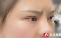 走出去别人都说我丑”，女子称整形后显老还丑，医美机构回应