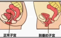 子宫脱垂不再难“托”：科学治疗重塑生命支撑