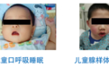 儿童腺样体面容防控新方案：清雷科技创新医疗器械守护黄金睡眠