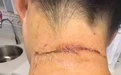 毒液堪比硫酸！杭州女子摸了下脖子就“中招” 有人差点毁容