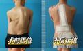 从1米35到1.6米！藏族女孩得西拉姆的“挺直”新生