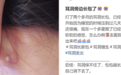 为什么没有人告诉我　打耳洞后会长这种肉疙瘩