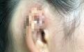 年轻人爱美打耳洞，千万要注意，避免留下终身遗憾