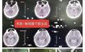 生死竞速！世博高新医院紧急救治脑动脉瘤破裂患者