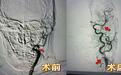 突发昏迷 济南南郊医院脑科团队急诊介入取栓成功救治急性脑梗死患者