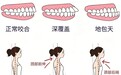 早预防 早干预 少走正畸弯路 惠州口腔医院专家呼吁正畸治疗需把握“黄金期”