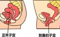 子宫脱垂≠子宫切除！三亚中心医院 LLS 微创术，守护女性 “完整人生”