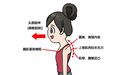 告别“乌龟颈”　拯救上交叉综合症