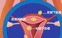 子宫肌瘤要不要手术　一直长下去会不会癌变