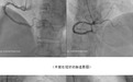 全国首批！齐鲁医院急诊科介入团队成功开展CorVad4.0辅助下高危复杂PCI手术