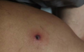 被小虫子咬后，出现这种黑色焦痂，千万别大意