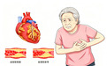 守护“心”健康：一文读懂冠心病的防与治