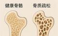 骨头“偷偷变脆”？济南南郊医院医生教你科学护骨