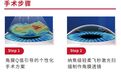 阳光融和医院正式引进第二代个性化全飞秒——CLEAR超清全飞设备，屈光手术迈入“个性化精准矫正”新时代