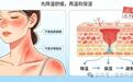 晒红发烫脱皮别乱敷　夏季晒伤修复的正确姿势