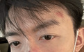 谭坤伦拍戏意外鼻骨受伤 剧组用新增戏份慰问补偿