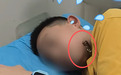 长沙12岁男孩湖边玩耍被它一口“咬”脸！暑假尚未结束，家长们注意了