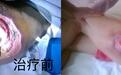 压疮久治不愈怎么办？中西医结合“三位一体”疗法打破愈合困局