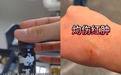 高价淡斑不等于高效，暗访调查揭开行业另一面