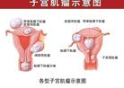 是不是发现子宫肌瘤就一定要手术? 打开