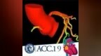 ACC2019丨DEFINE <em>PCI</em>：仅凭造影就判定<em>PCI</em>血运重建成功？生理学评估助力发现残余缺血
