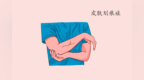 <em>皮肤</em>血管的过敏反应——<em>皮肤</em>划痕症