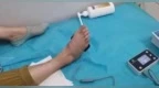 小便功能“丢失”？别担心，这项技术助力排尿自由