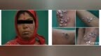 26 岁女性全身长满「小蘑菇」，只换了一种药，病好了