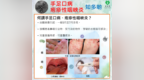 衞生局接獲1宗腸病毒羣集性感染報告