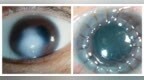 角膜盲患者的福音 郑州爱尔眼科医院角膜移植正式通过医疗技术备案