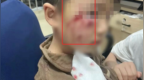 河南3岁男孩被流浪狗咬伤打了疫苗为啥也没用？