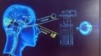 抑郁症光照疗法 开启精神健康治疗新篇章
