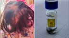 医院回应3岁女孩铊中毒：是人为投毒