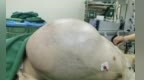 体内长35公斤肉瘤　男子竟以为自己发胖了