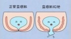 一抬腿就漏尿，三年难出门！49岁女子患“社交癌” 专家用这个技术还她“自由”