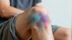 没磕没碰一身淤青？是“鬼捏青”还是身体警报？