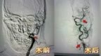 突发昏迷 济南南郊医院脑科团队急诊介入取栓成功救治急性脑梗死患者
