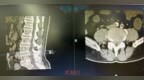 世界脊柱健康日丨椎管狭窄致腿疼5年 1小时微创解决