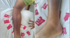 男子踩中蛇窝，至少被3条毒蛇咬了10多口