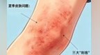 夏天皮肤科爆满　三大“刺客”你躲哪个