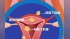 子宫肌瘤要不要手术　一直长下去会不会癌变